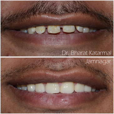 Slider image (3) Dr. Bharat Katarmal Dental and Implant Clinic